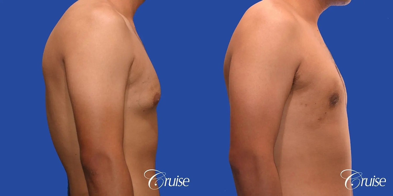 Gynecomastia Surgery Before & After