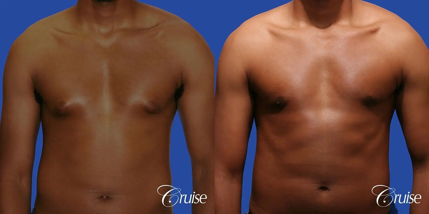 Gynecomastia Surgery Before & After