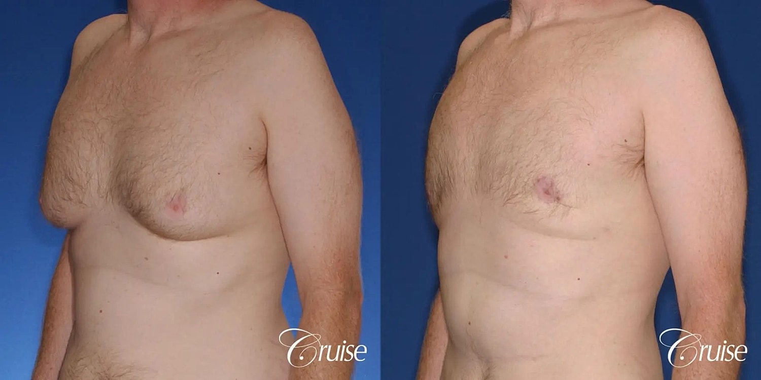 Gynecomastia Surgery Before & After