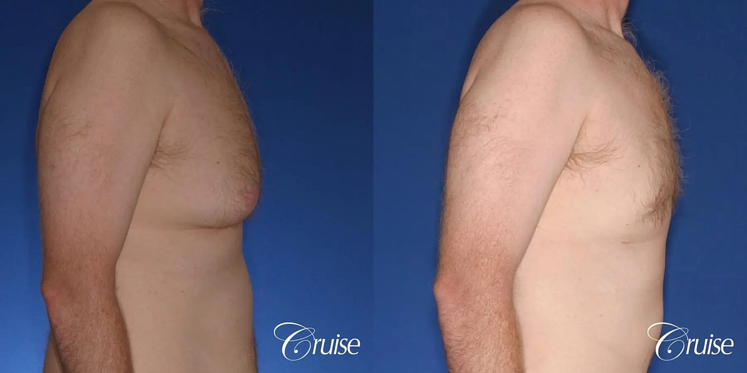 Gynecomastia Surgery Before & After