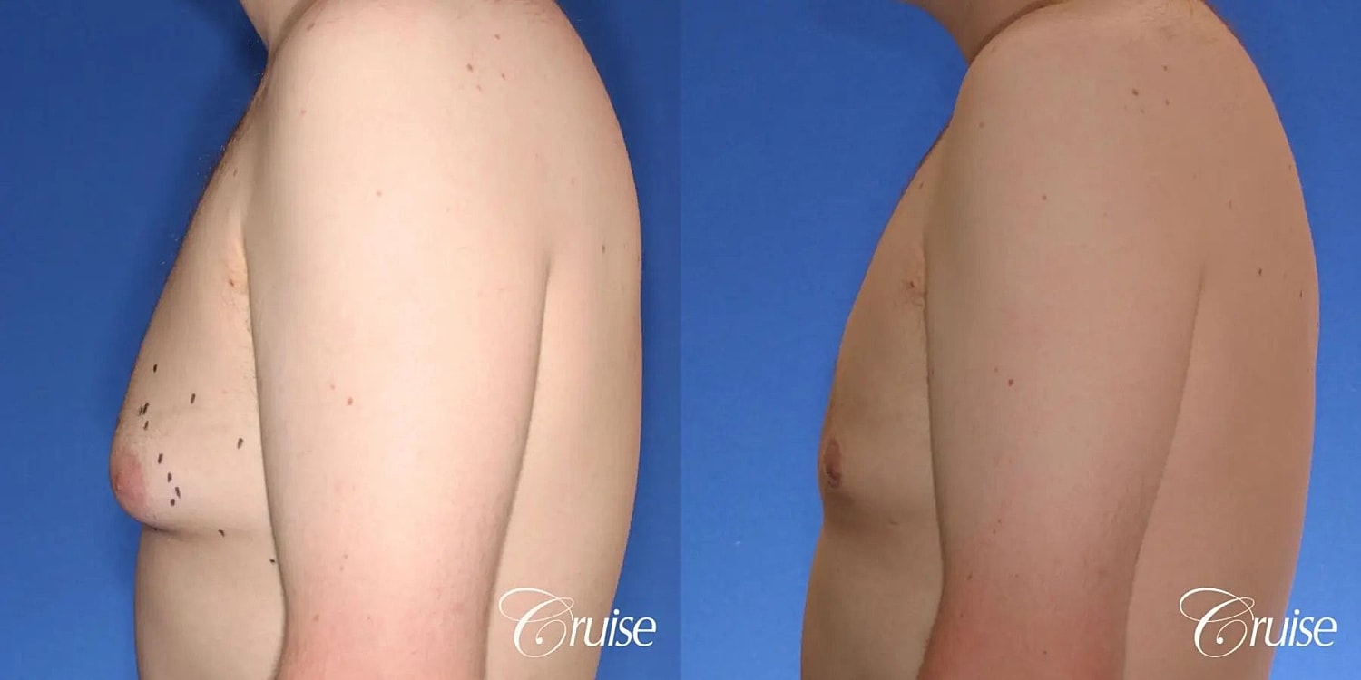 Gynecomastia Surgery Before & After