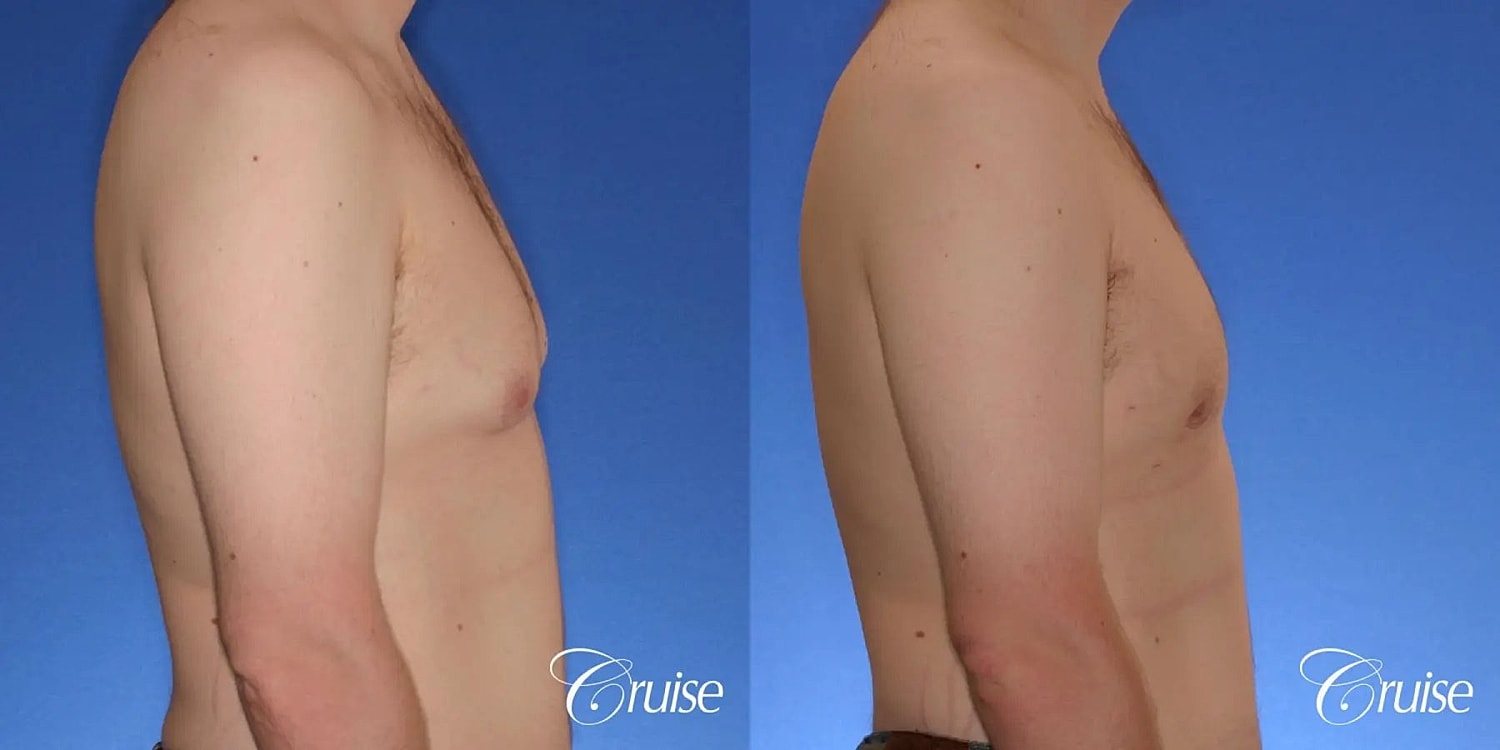 Gynecomastia Surgery Before & After