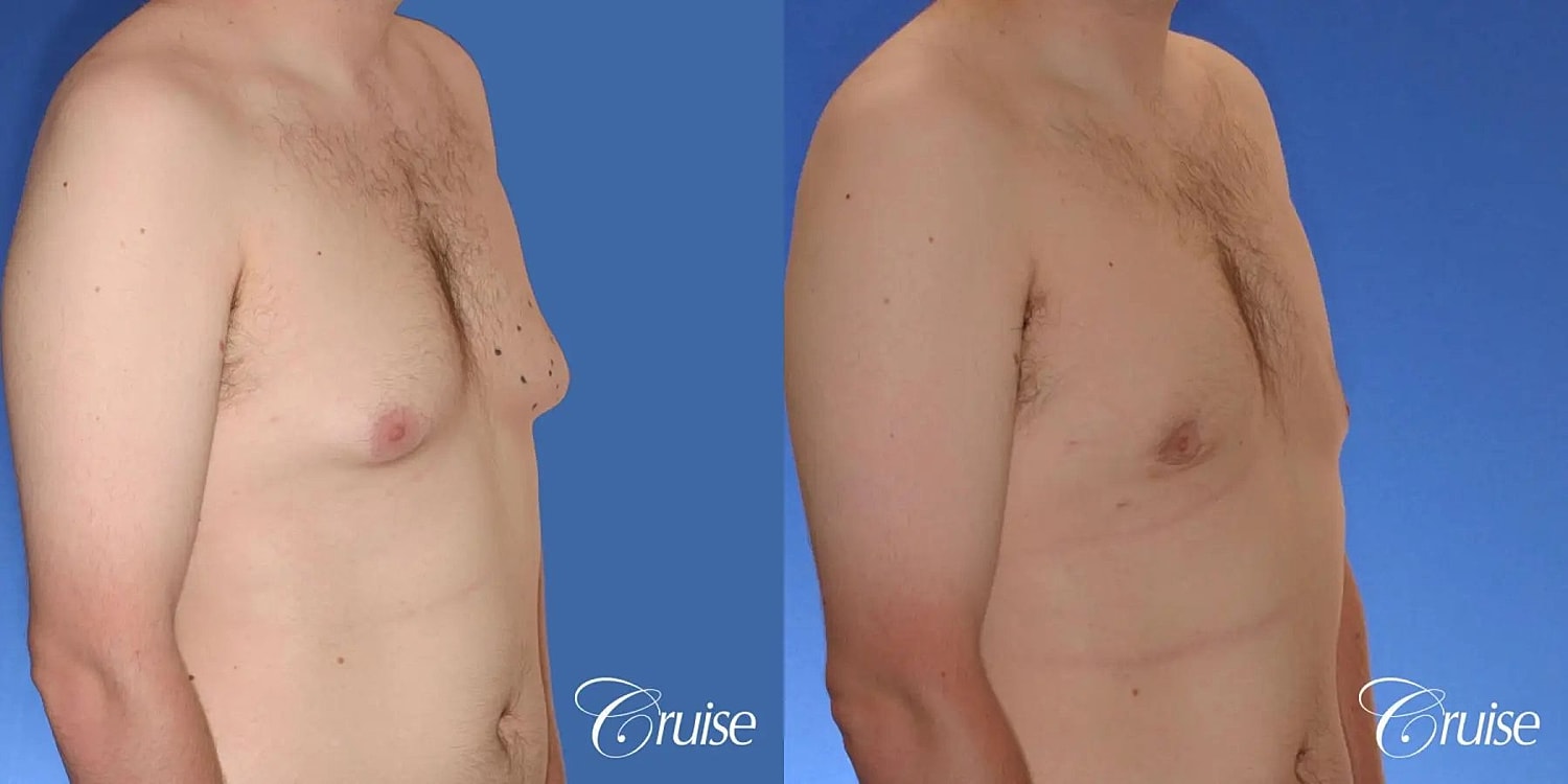 Gynecomastia Surgery Before & After