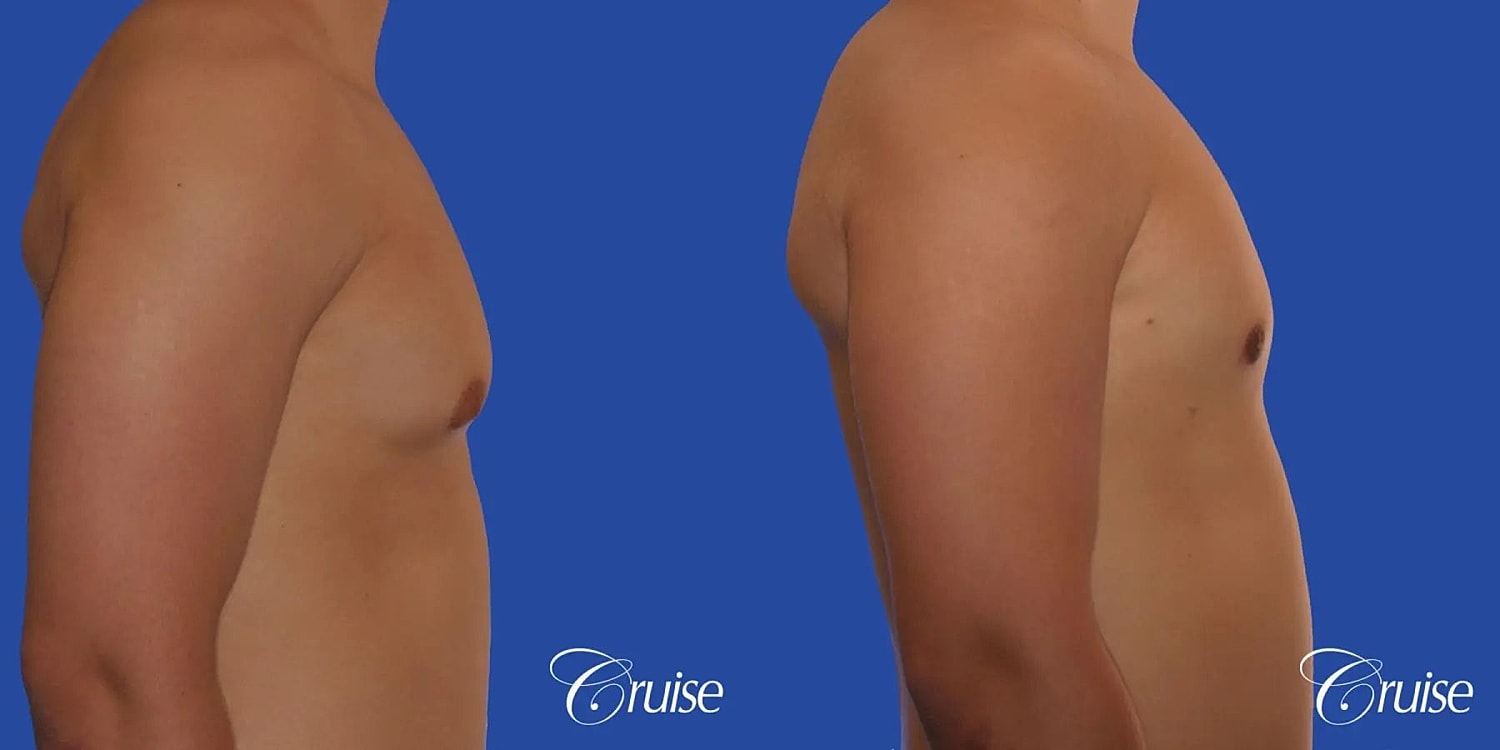 Gynecomastia Surgery Before & After
