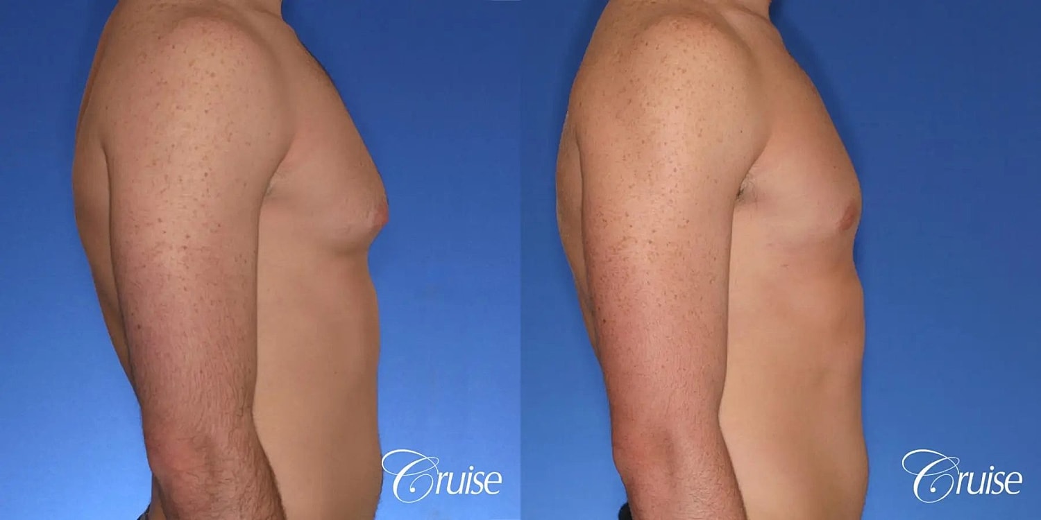 Gynecomastia Surgery Before & After
