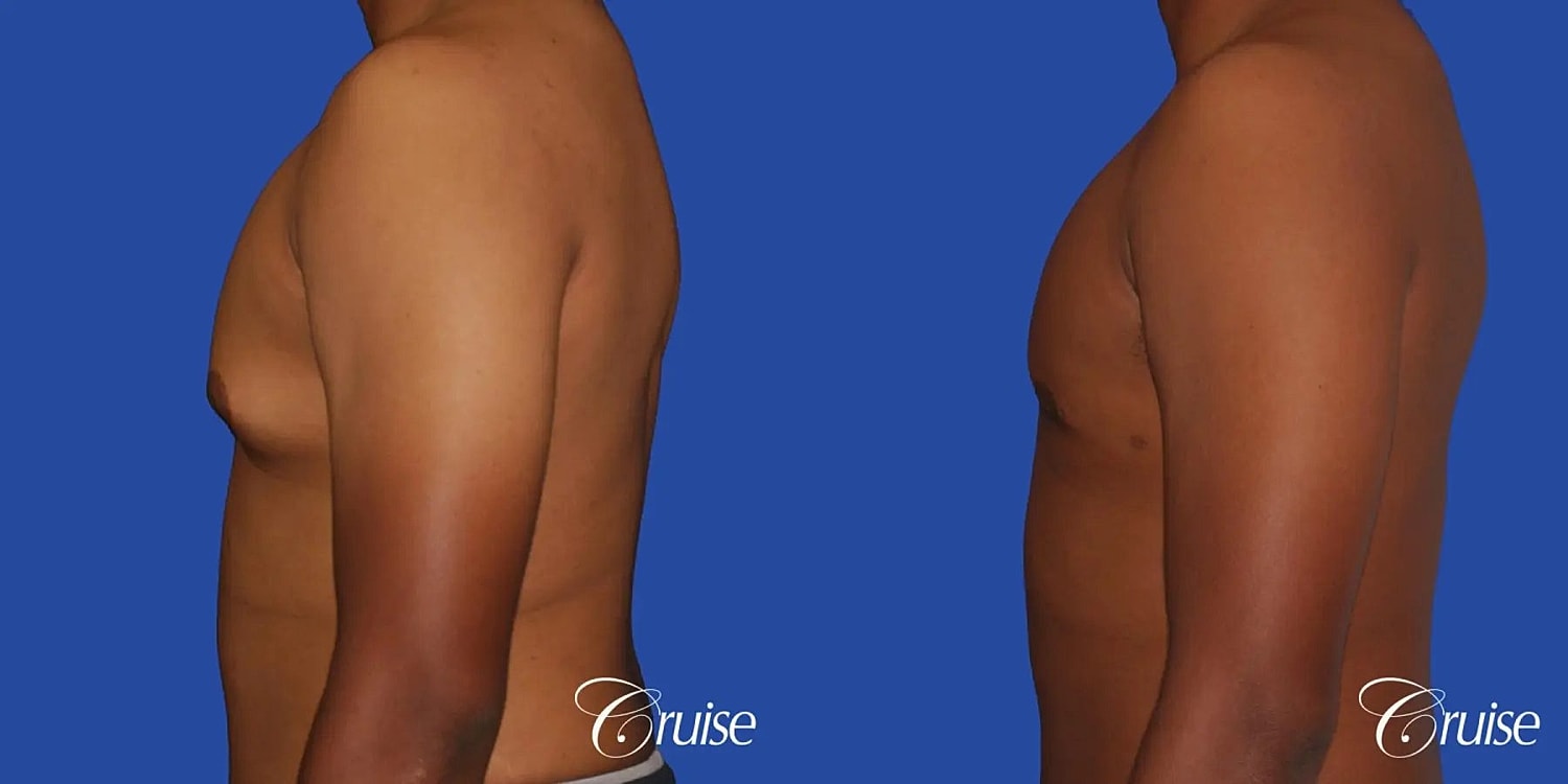 Gynecomastia Surgery Before & After