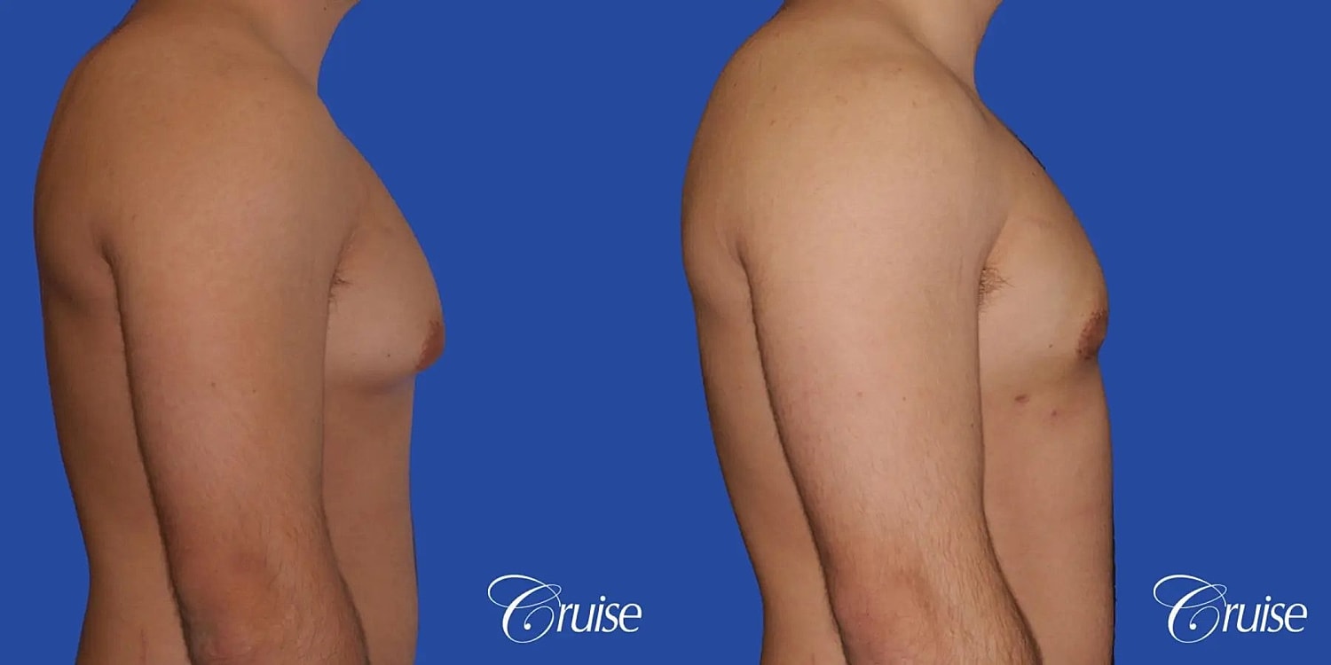 Gynecomastia Surgery Before & After