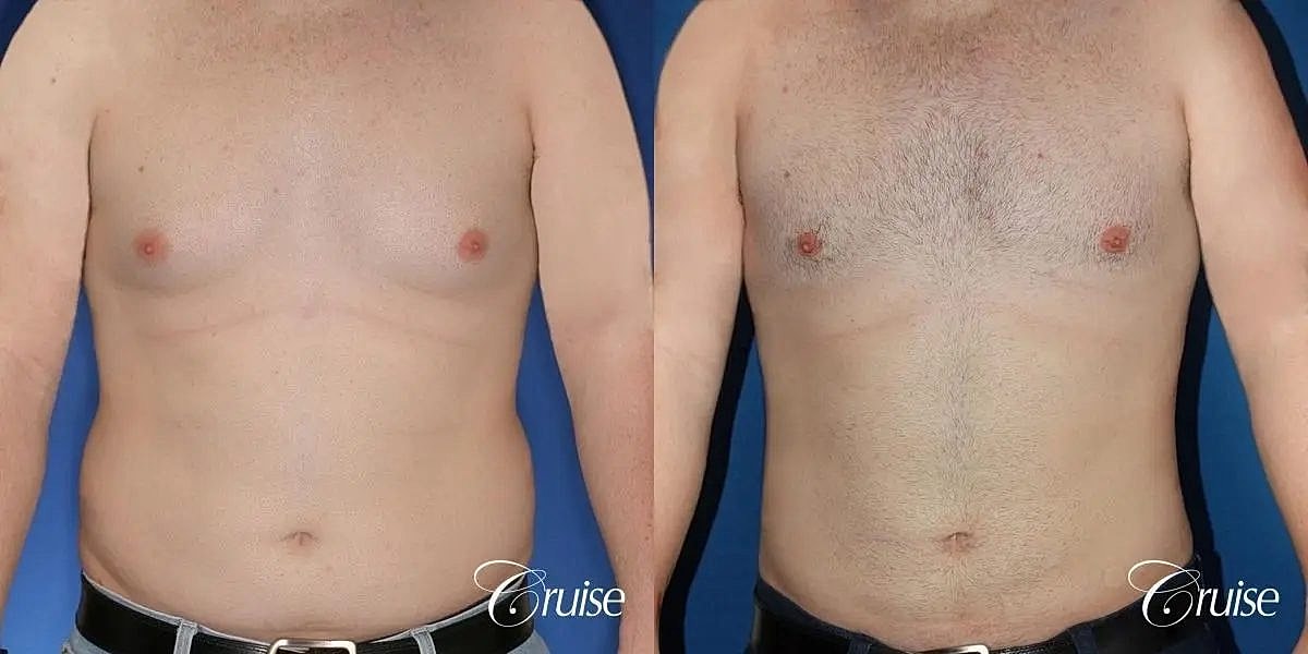 Gynecomastia Surgery Before & After