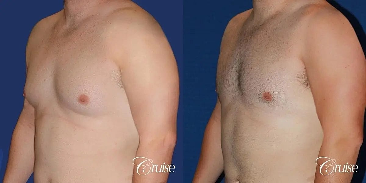 Gynecomastia Surgery Before & After