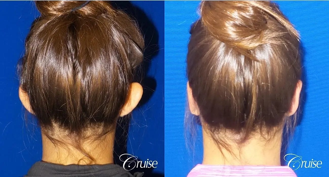 Otoplasty Earlobe Repair Before & After