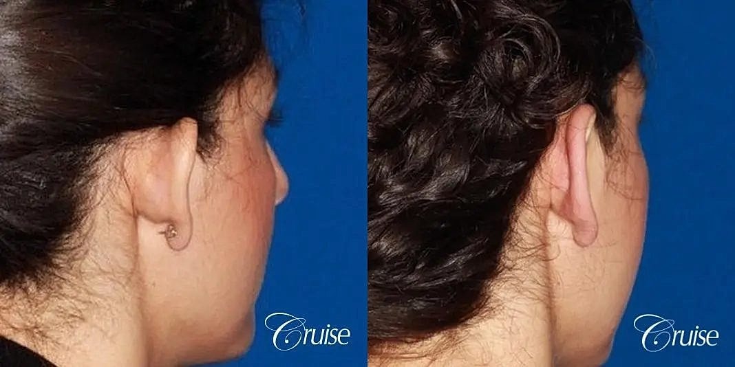 Otoplasty Earlobe Repair Before & After