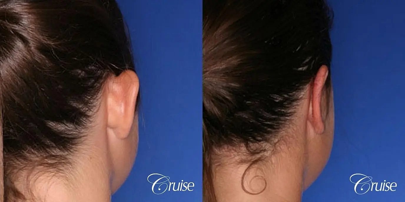 Otoplasty Earlobe Repair Before & After