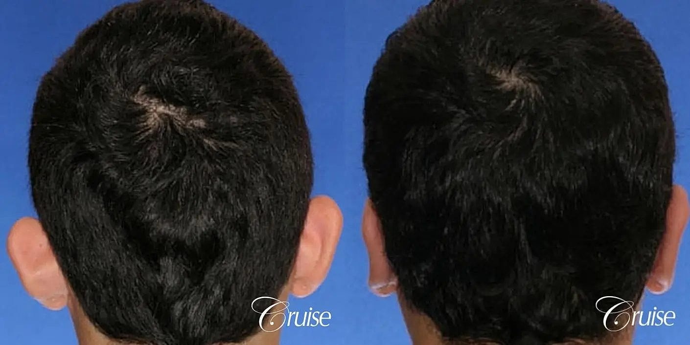 Otoplasty Earlobe Repair Before & After