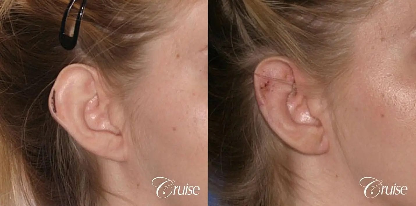 Otoplasty Earlobe Repair Before & After
