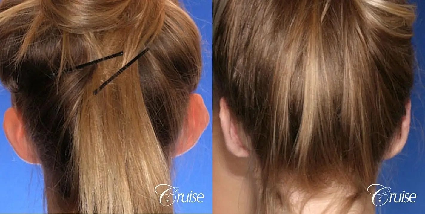 Otoplasty Earlobe Repair Before & After