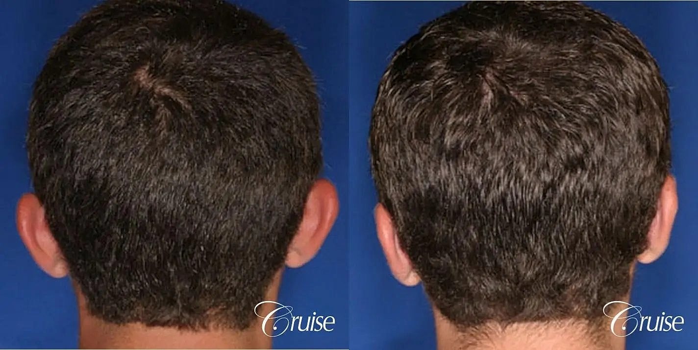 Otoplasty Earlobe Repair Before & After