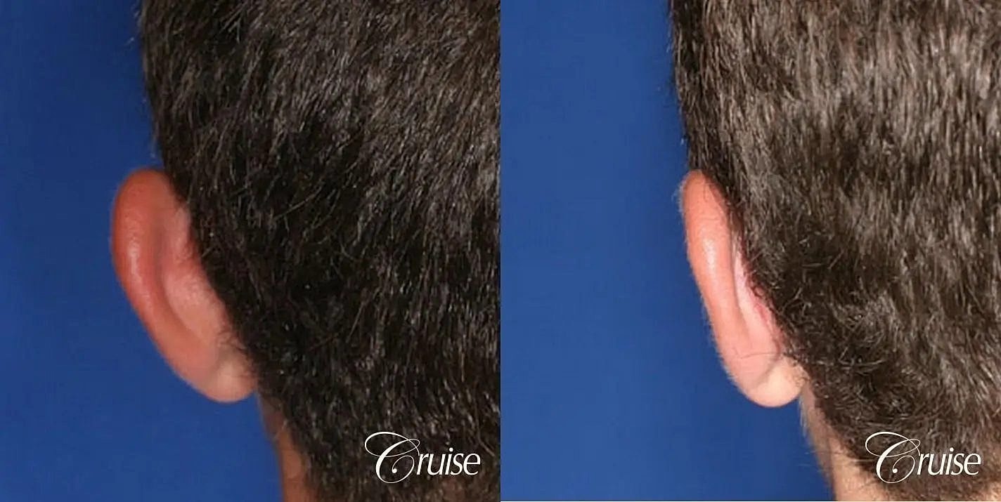 Otoplasty Earlobe Repair Before & After