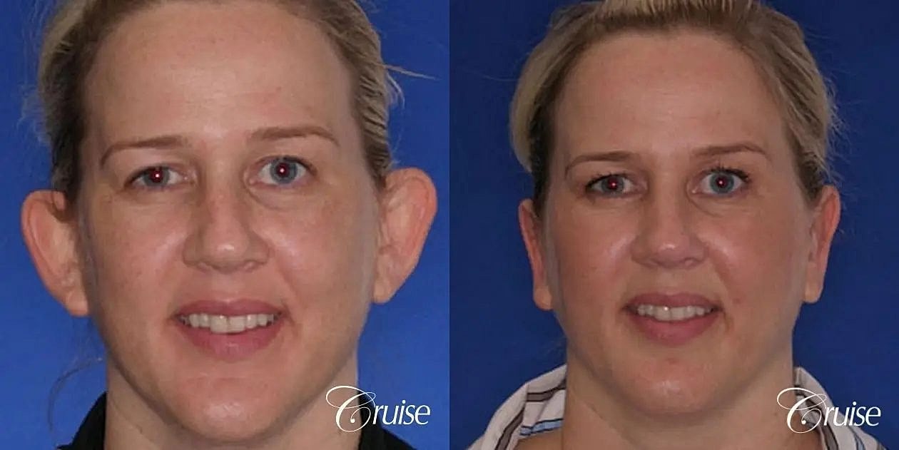Otoplasty Earlobe Repair Before & After