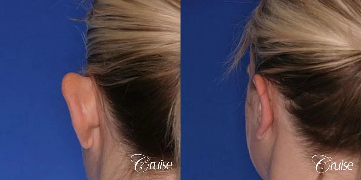 Otoplasty Earlobe Repair Before & After