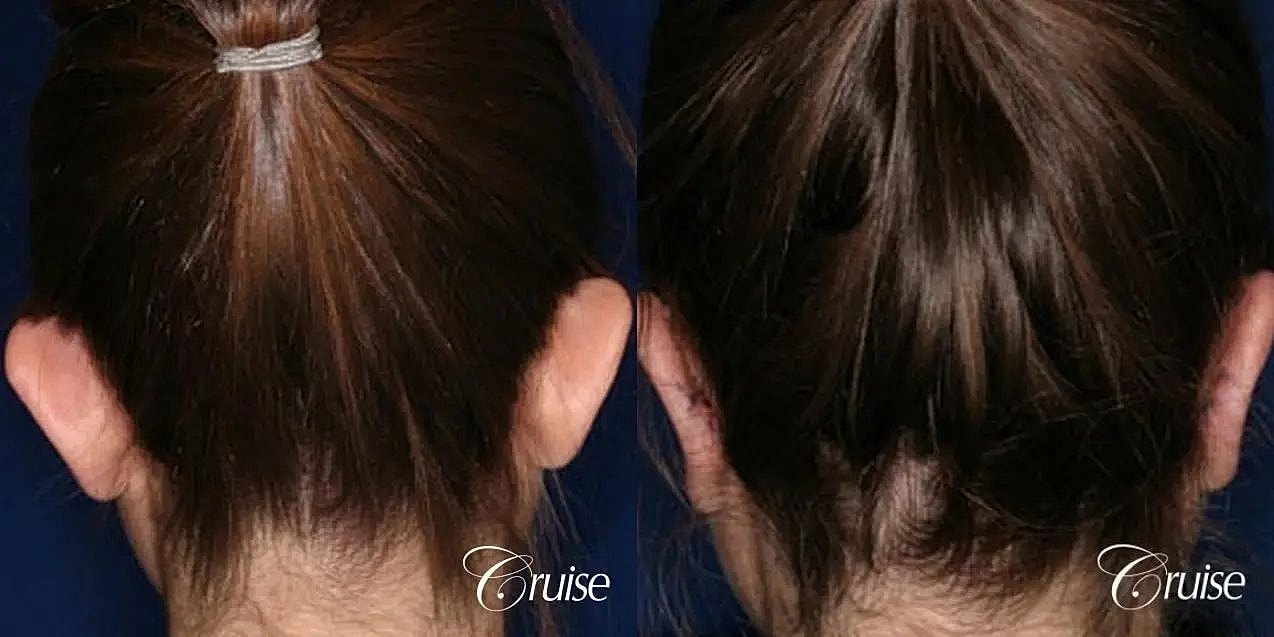 Otoplasty Earlobe Repair Before & After