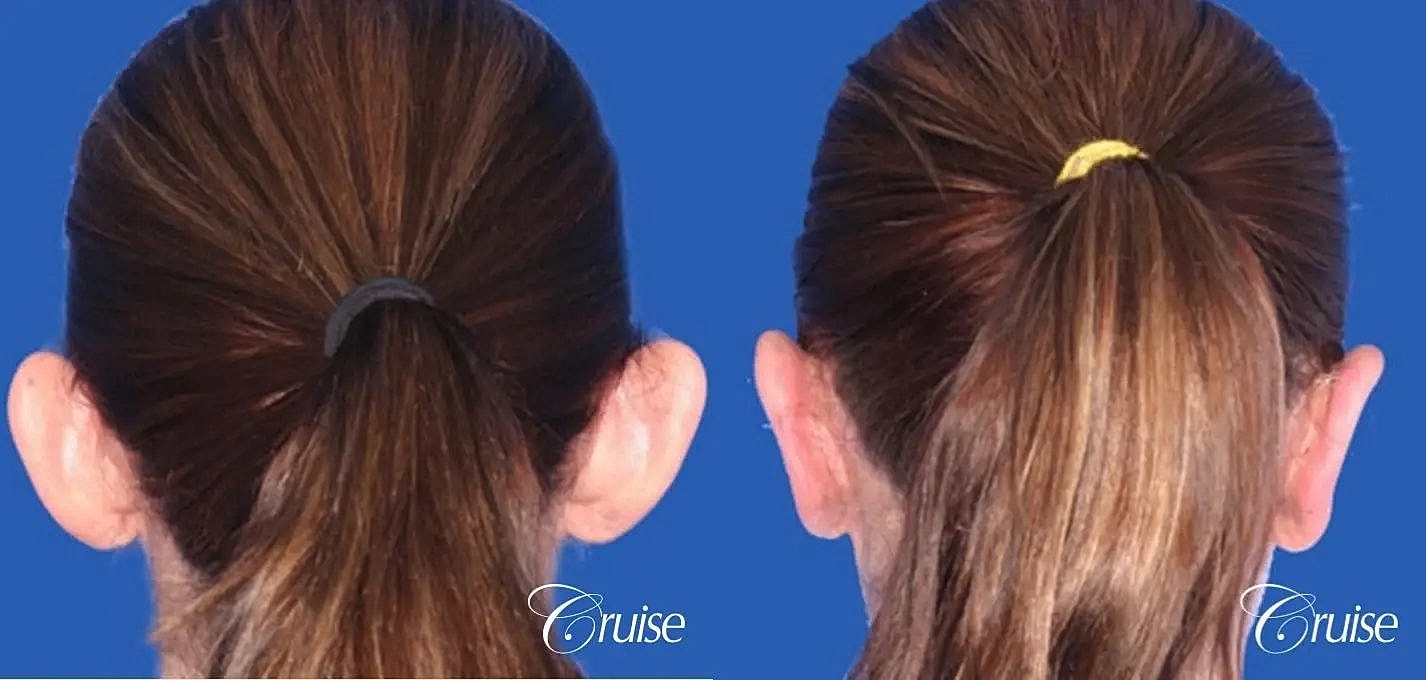 Otoplasty Earlobe Repair Before & After