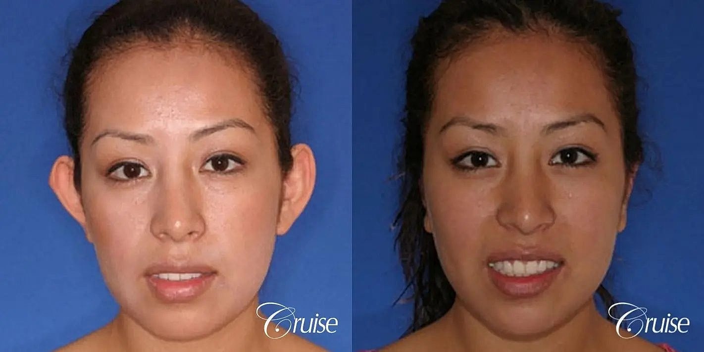 Otoplasty Earlobe Repair Before & After