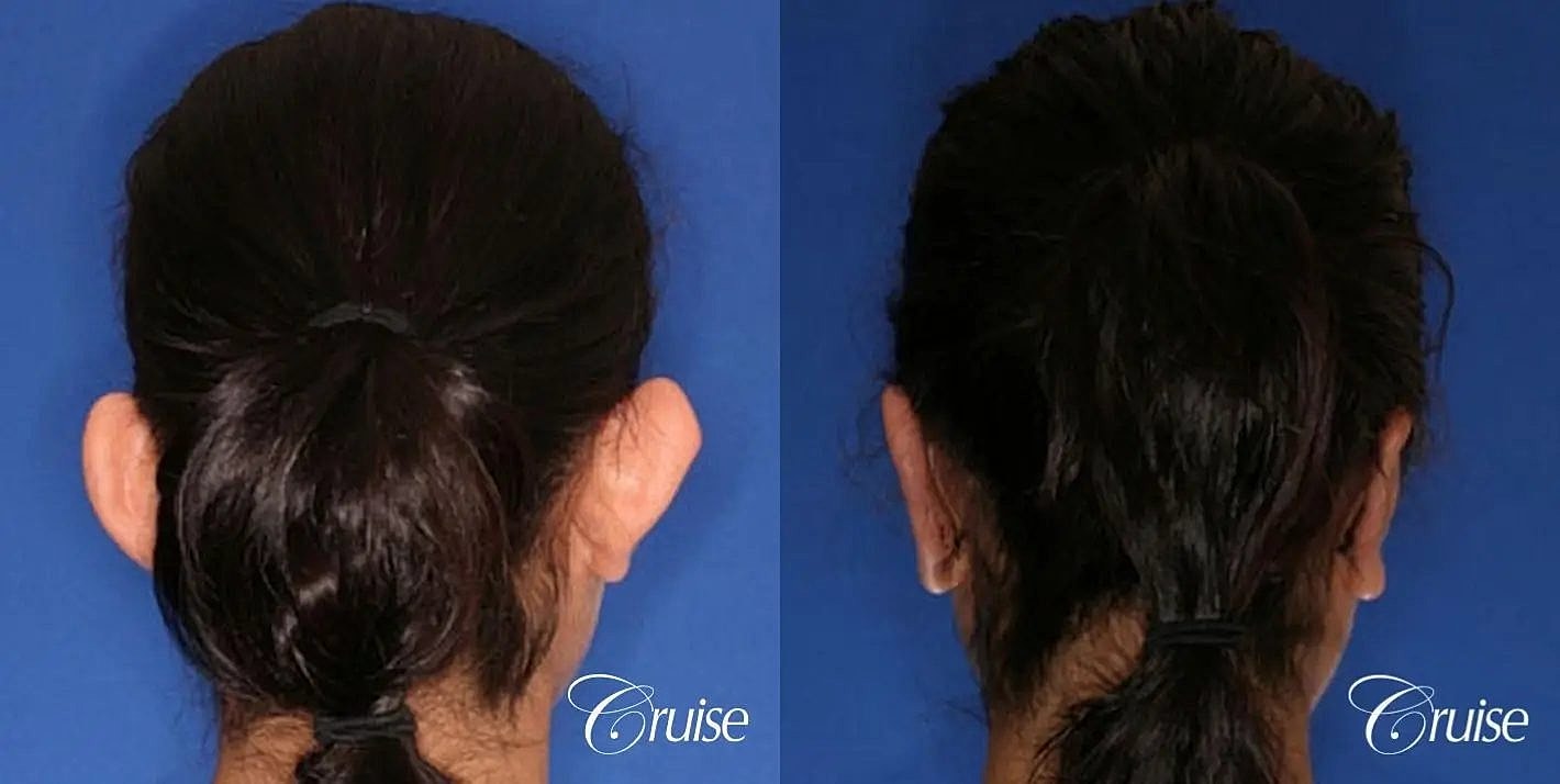 Otoplasty Earlobe Repair Before & After