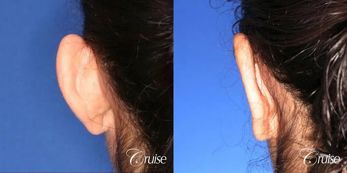 Otoplasty Earlobe Repair Before & After