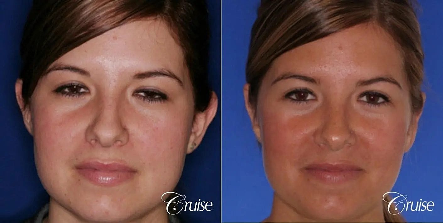 Otoplasty Earlobe Repair Before & After