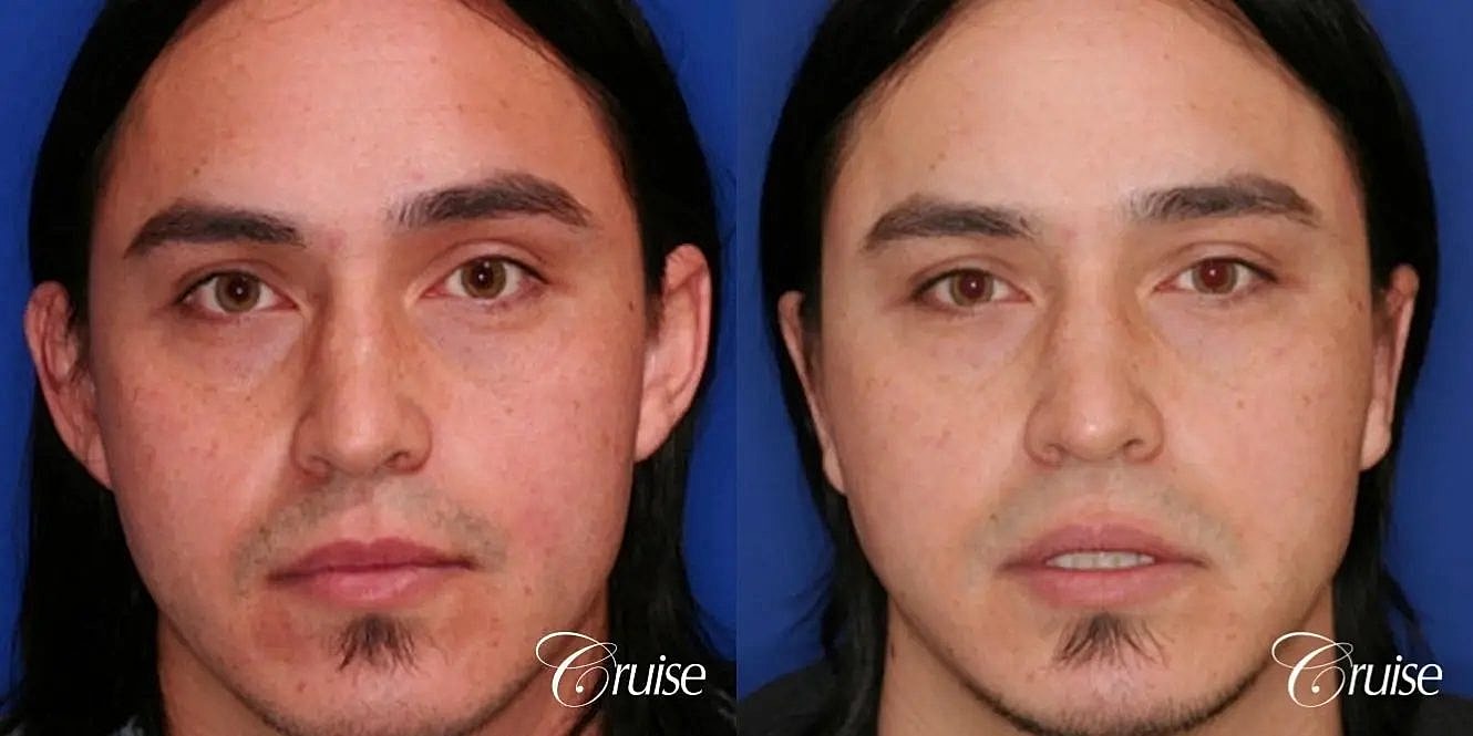 Otoplasty Earlobe Repair Before & After