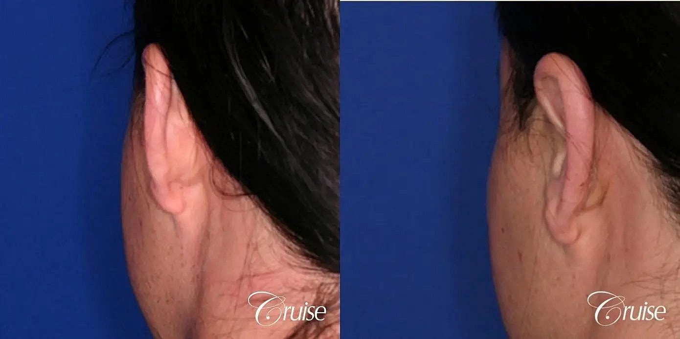 Otoplasty Earlobe Repair Before & After
