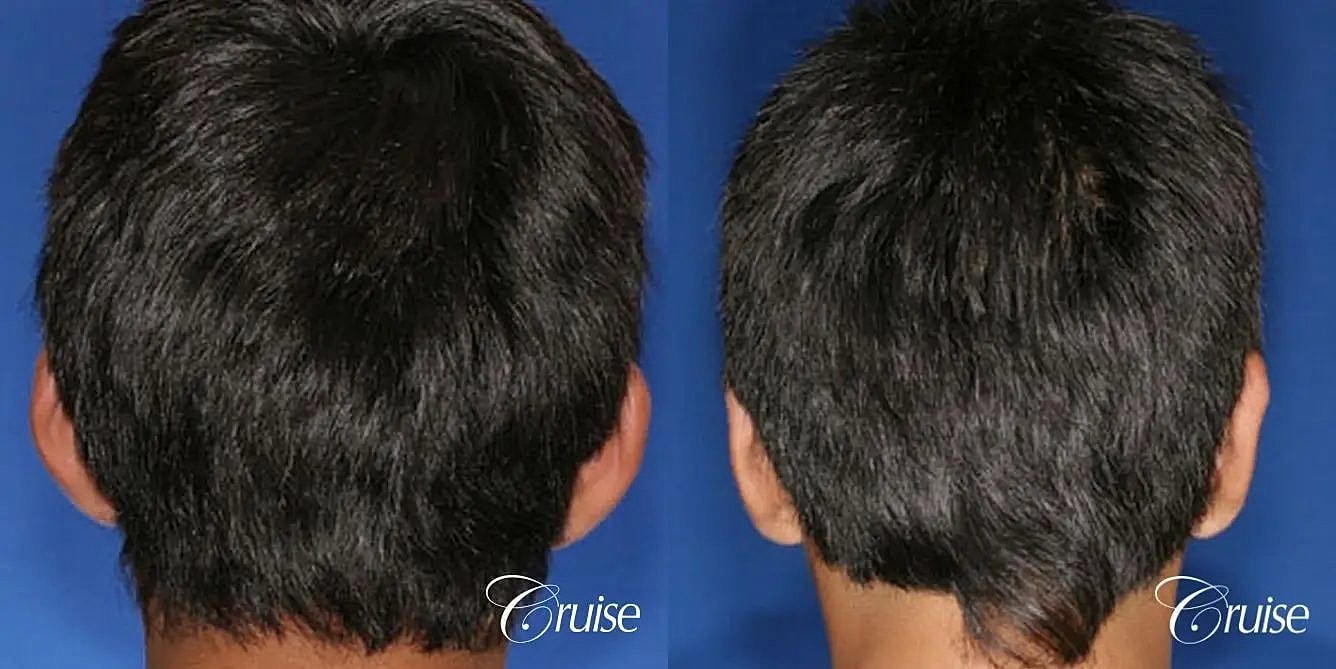 Otoplasty Earlobe Repair Before & After