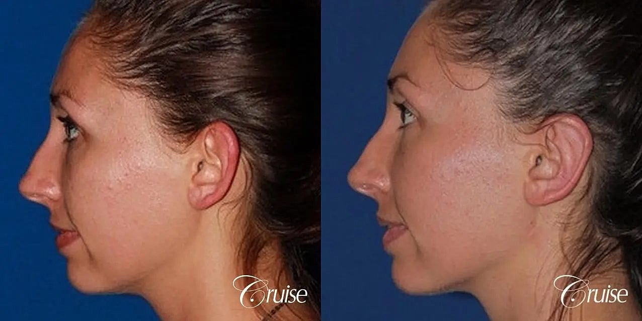 Otoplasty Earlobe Repair Before & After