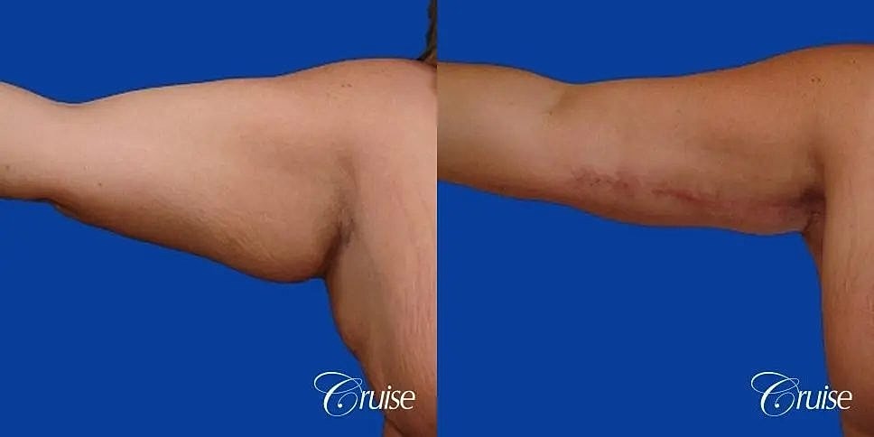 Arm Lift Before & After