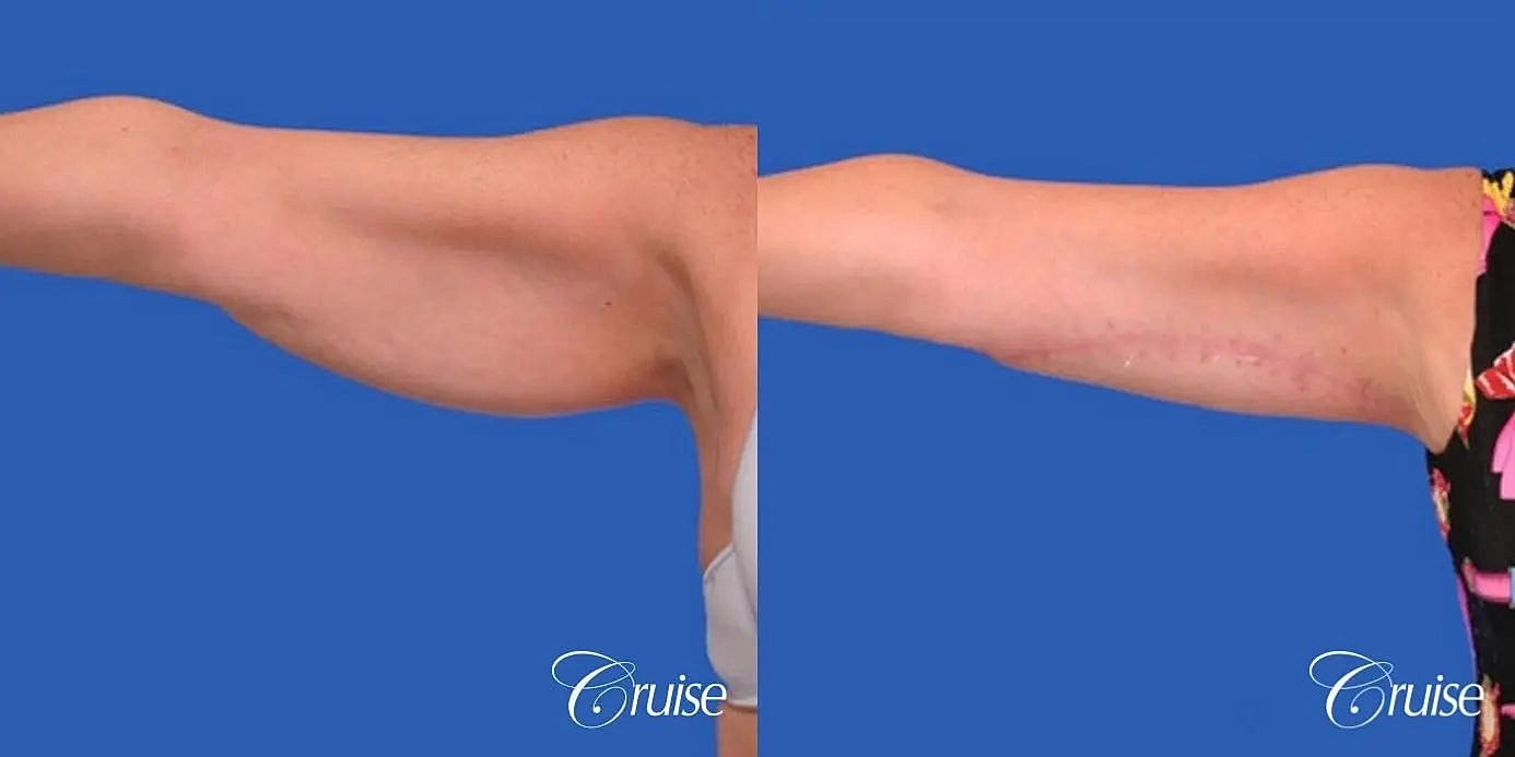 Arm Lift Before & After