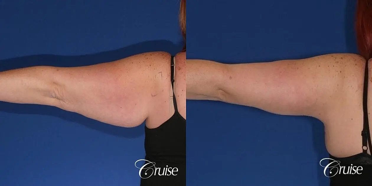 Arm Lift Before & After