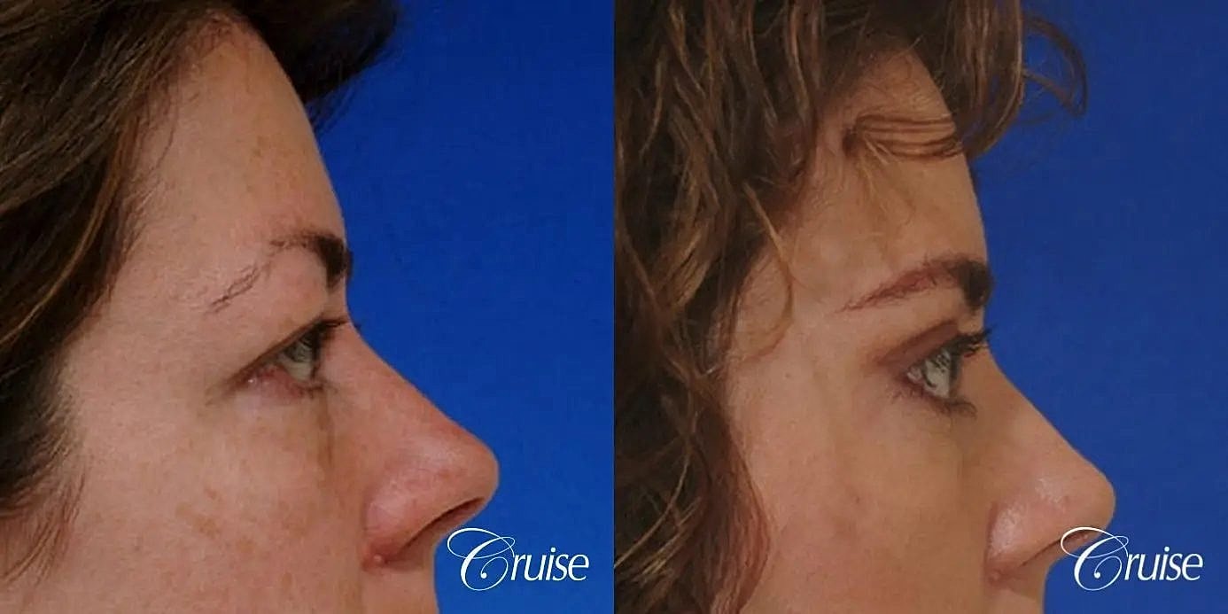 Blepharoplasty Before & After