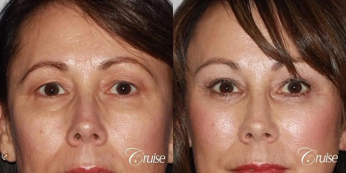 Blepharoplasty Before & After