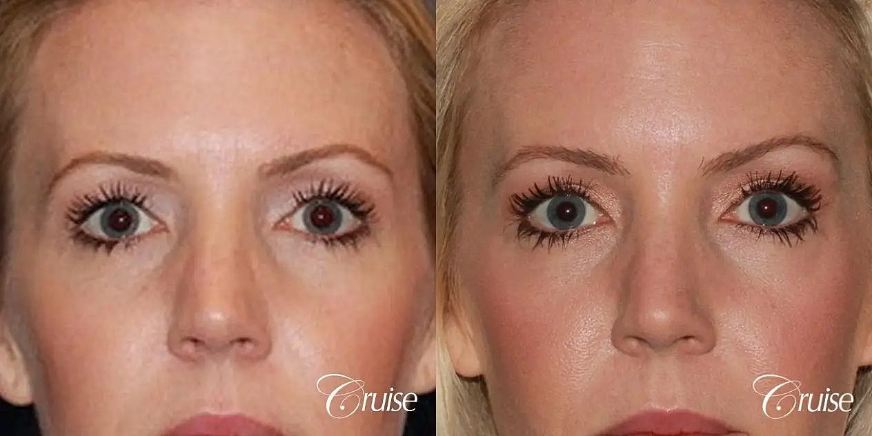 Blepharoplasty Before & After