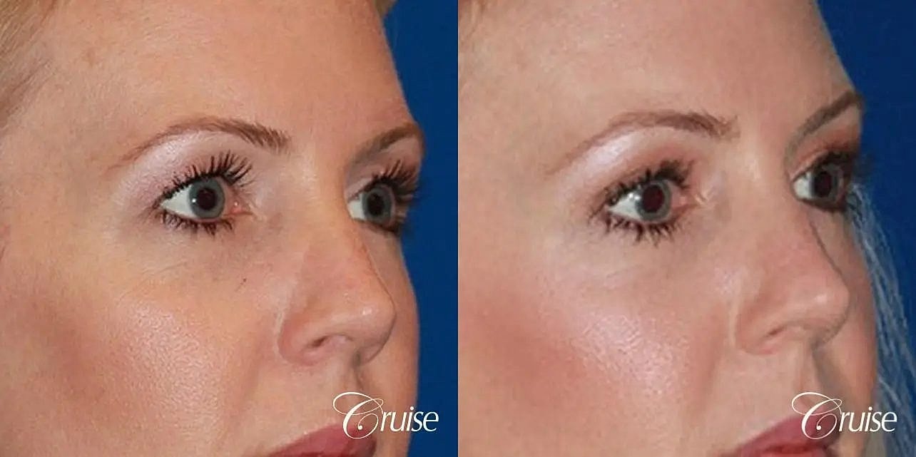 Blepharoplasty Before & After