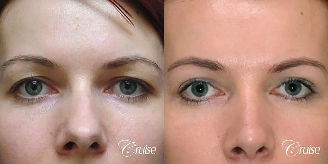 Blepharoplasty Before & After