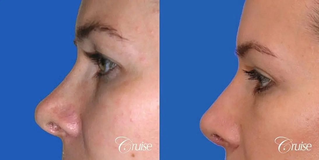 Blepharoplasty Before & After