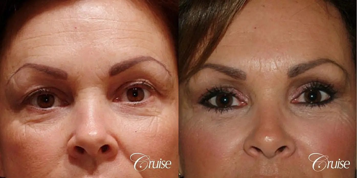 Blepharoplasty Before & After