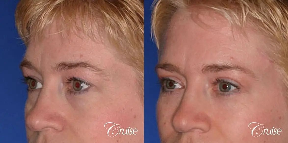 Blepharoplasty Before & After