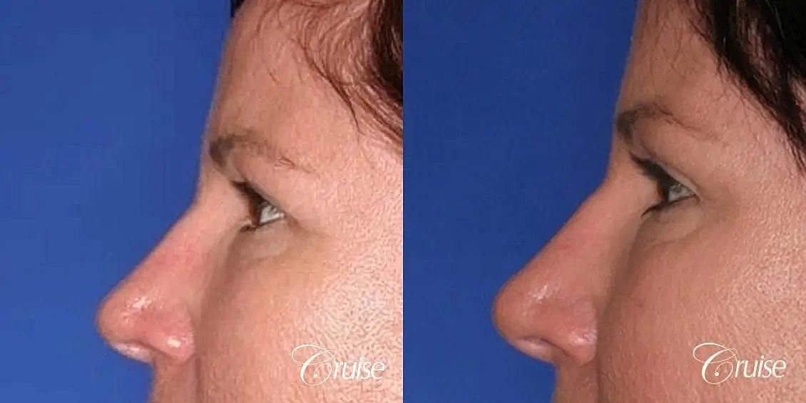 Blepharoplasty Before & After
