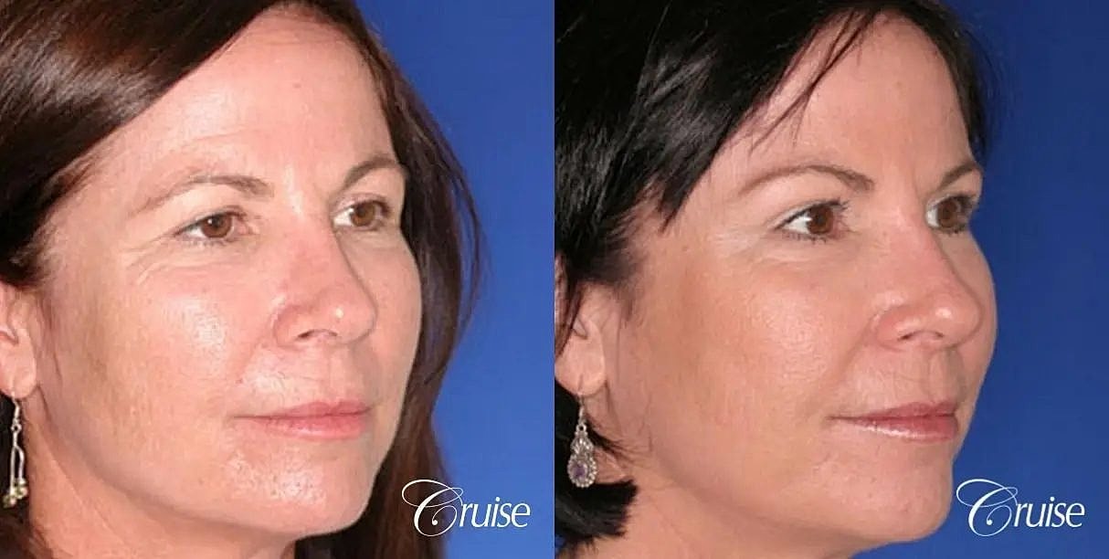 Blepharoplasty Before & After