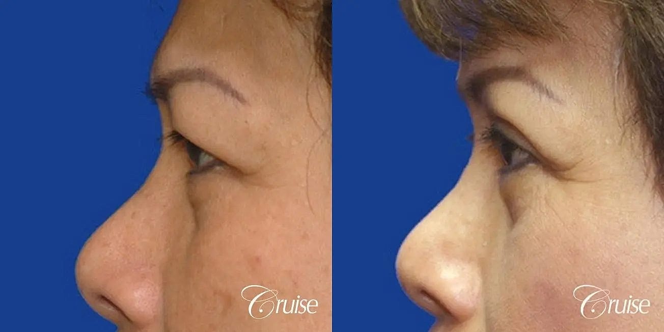 Blepharoplasty Before & After
