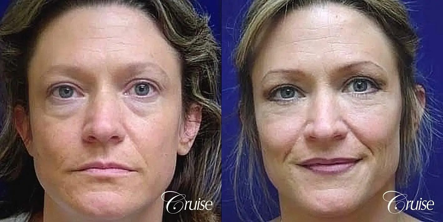 Blepharoplasty Before & After