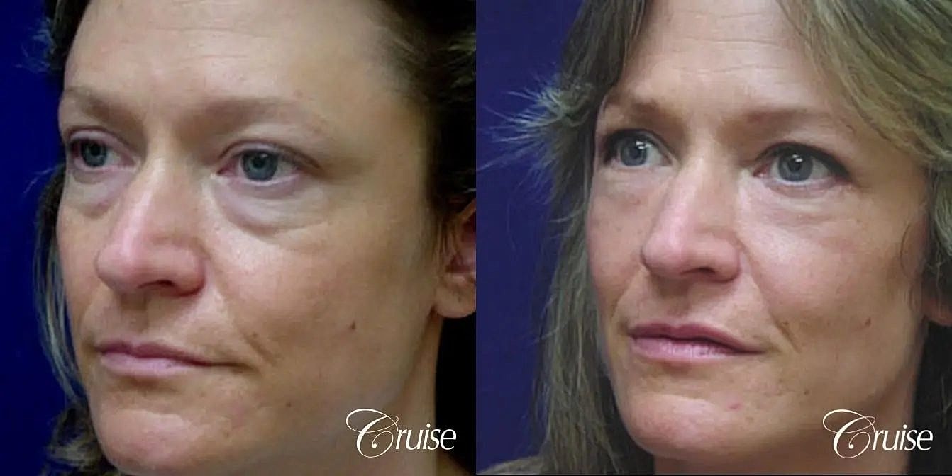 Blepharoplasty Before & After