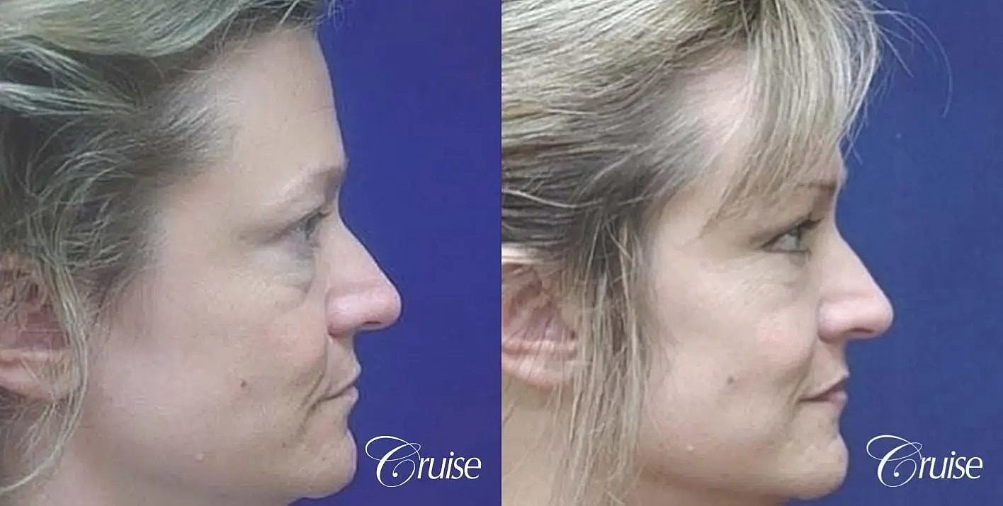 Blepharoplasty Before & After